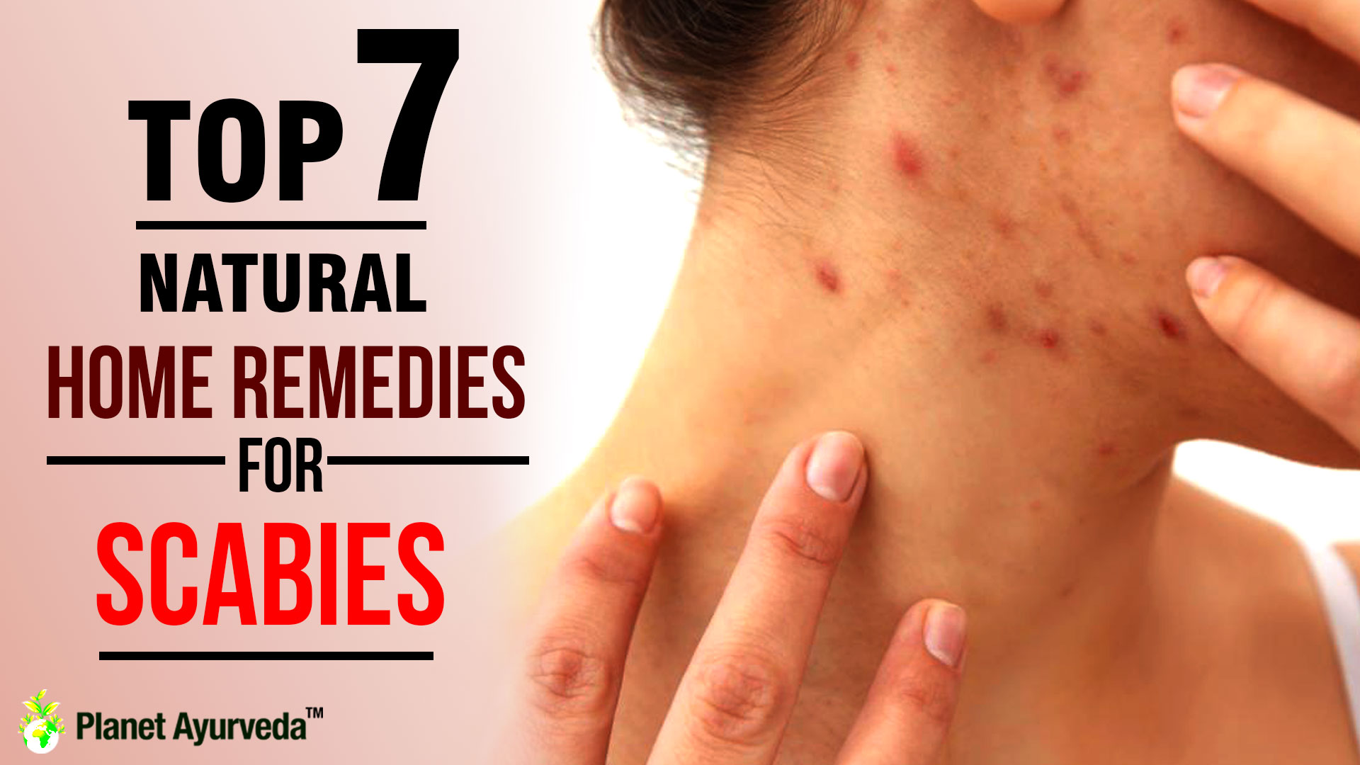 Natural Home Remedies for Scabies