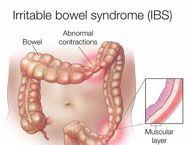 Irritable Bowel Syndrome 