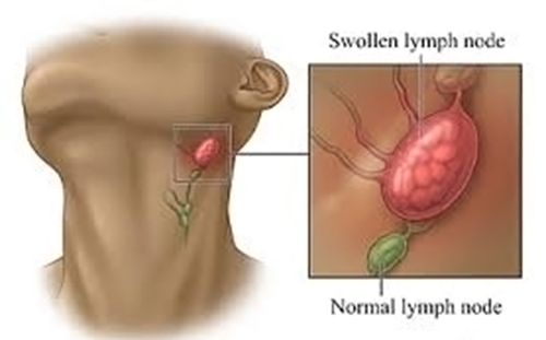 Swollen Lymph node