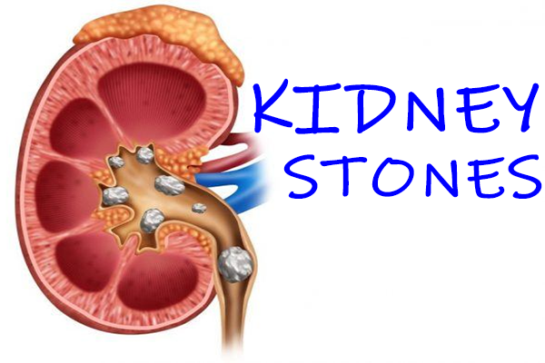 kidney stone