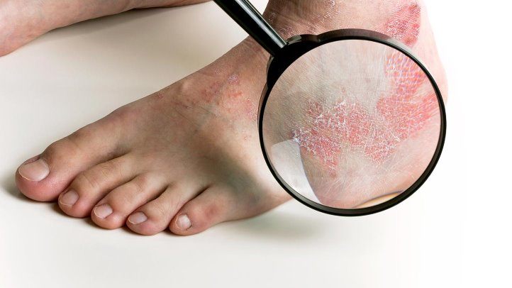 Psoriasis