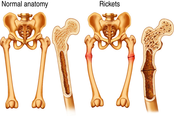Osteomalacia 