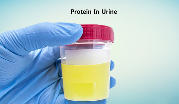 Proteinuria