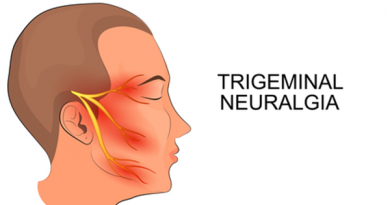 Trigeminal Neuralgia