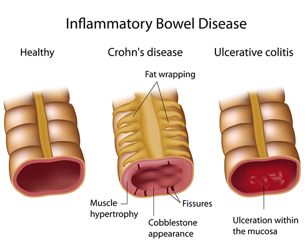 planet ayurveda ibd