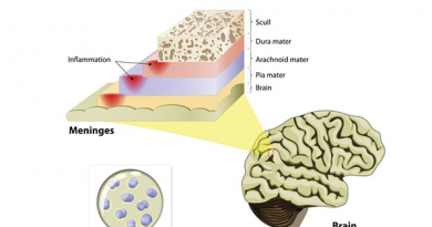 How Meningitis can be Treated Naturally?