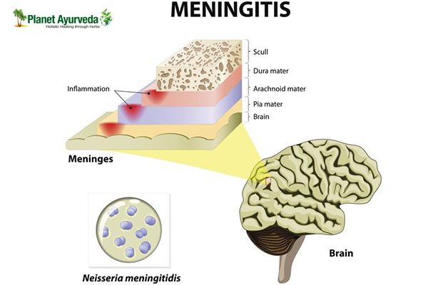 How Meningitis can be Treated Naturally?