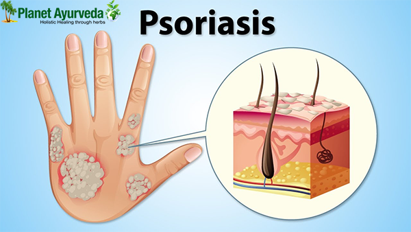 root cause of psoriasis in ayurveda