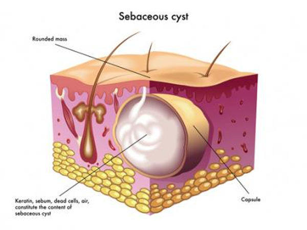 Sebaceous Cyst 