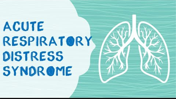 acute respiratory distress syndrome