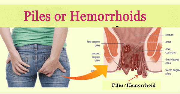Piles or Hemorrhoids