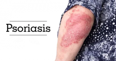 Psoriasis