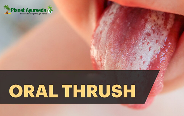 oral thrush.png