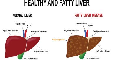fatty liver illustration