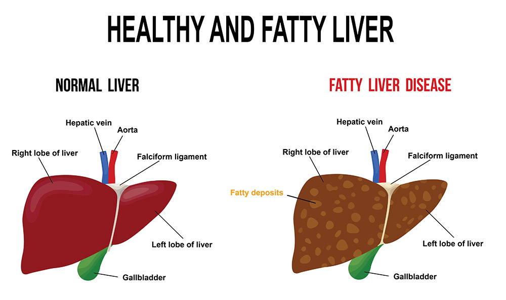 Fatty Liver Disease Tonsillitis