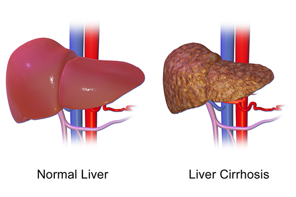 Cryptogenic (Chronic Liver Disease) 