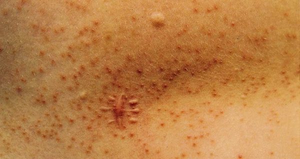 Cutaneous Mucinosis