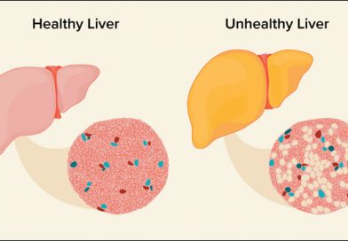 Clinically Tested Ayurvedic Support for Fatty Liver Health Fatty Liver