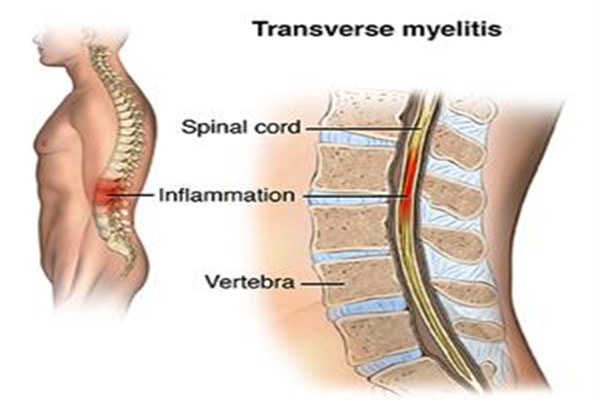 Transverse Myelitis