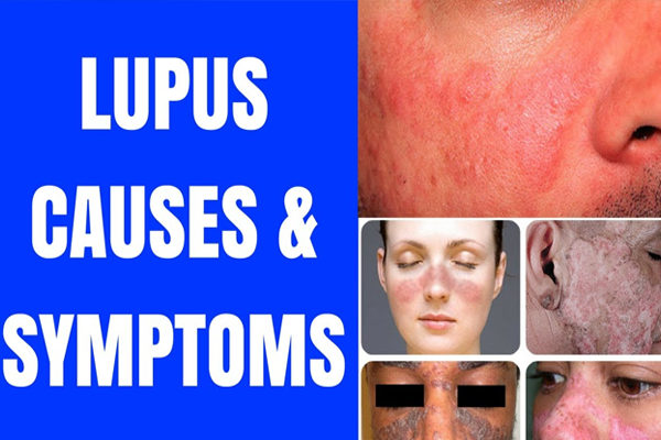 Do You Know About Lupus And Its Ayurvedic Treatment?