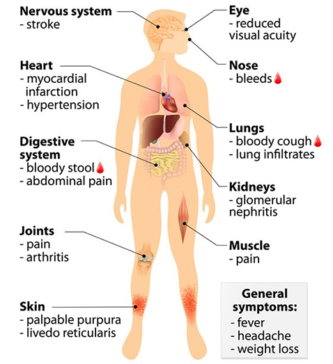 Wegeners Granulomatosis or Vasculitis