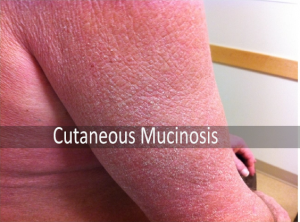 Herbal remedies for Cutaneous Mucinosis Archives - Planet Ayurveda