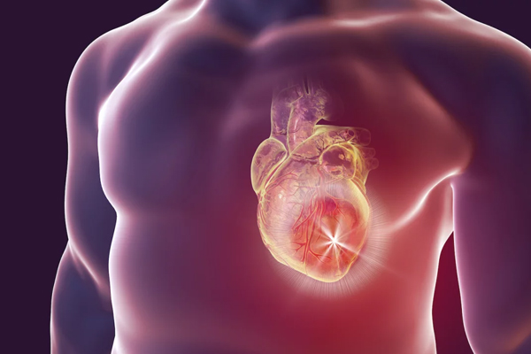 Hypertrophic Cardiomyopathy