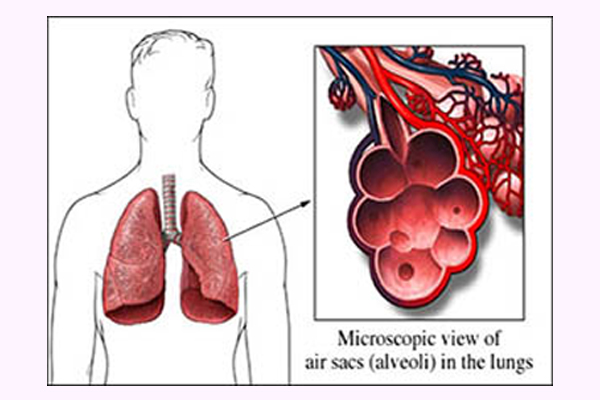 Allergic bronchopulmonary aspergillosis