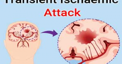 Transient Ischaemic Attack