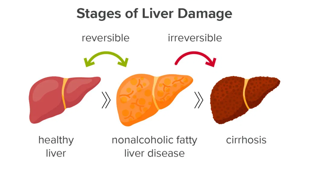non-alcoholic fatty liver disease