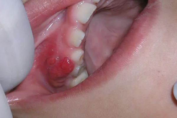 Canker sores and mucocele