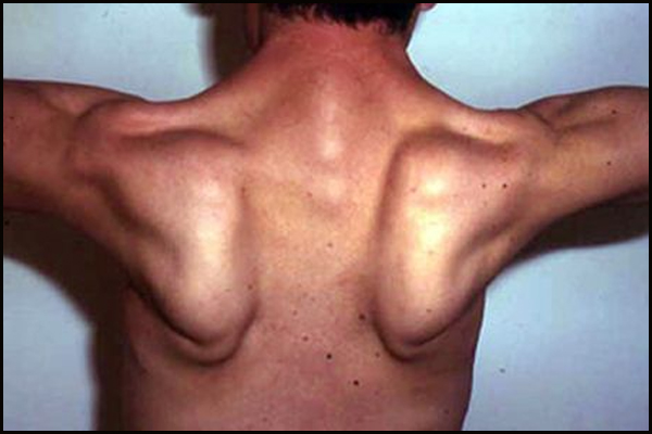 Limb Girdle Muscular Dystrophy