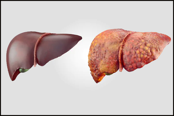 Liver Cirrhosis
