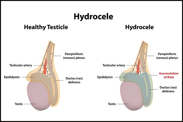 Hydrocele