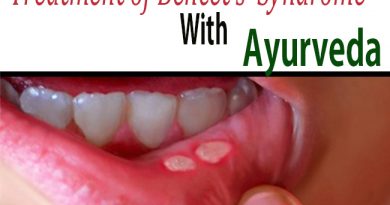 Behcet’s Syndrome