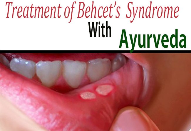 Behcet’s Syndrome