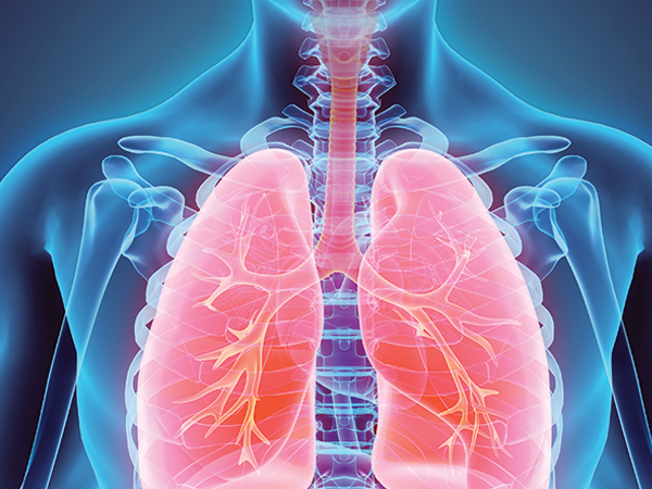 sarcoidosis