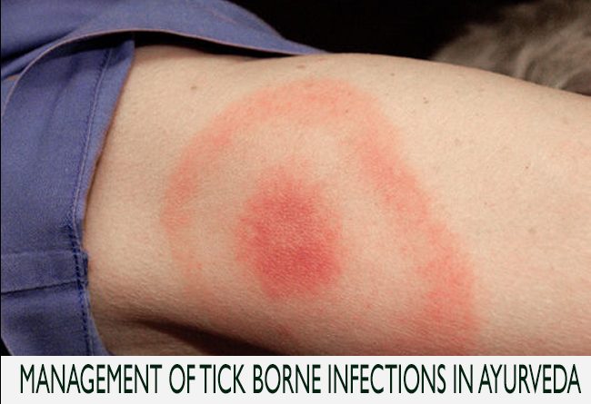 Management of Tick Borne Infections in Ayurveda