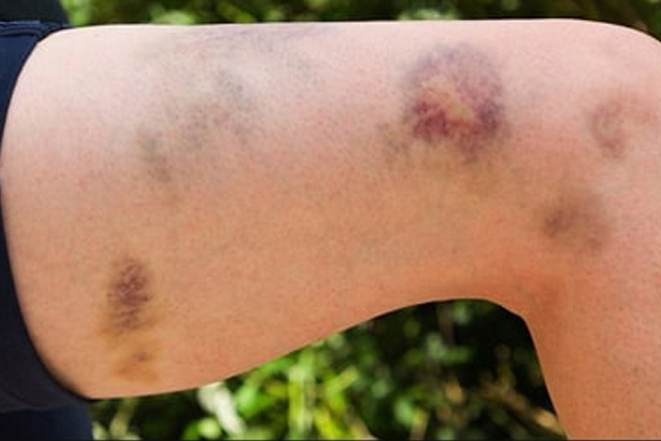 Idiopathic Thrombocytopenic Purpura