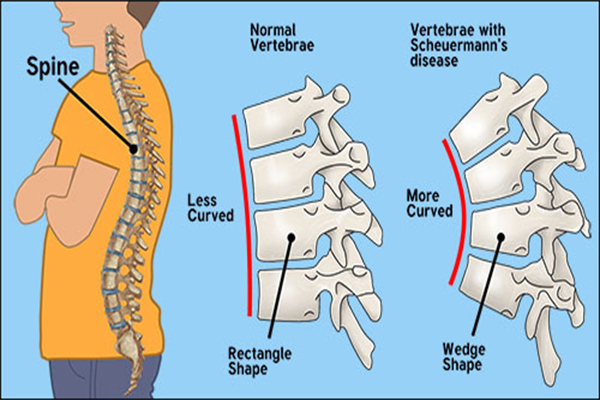 Scheuermann's Disease