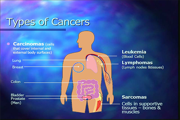 Types of Cancer