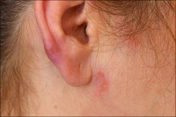 Sarcoidosis