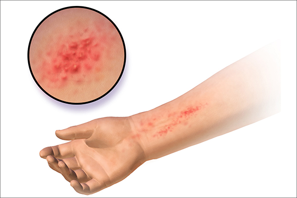 Dermatosis