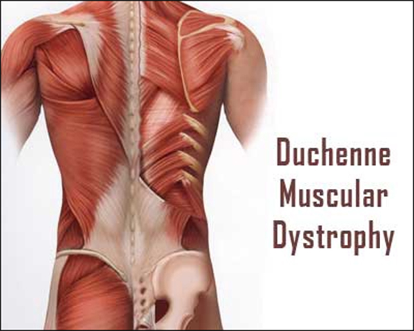 Duchenne Muscular Dystrophy