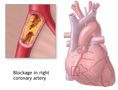 Right Coronary Artery Blockage