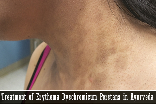Erythema Dyschromicum Perstans Coexistence Of Erythema Dyschromicum Erythema Dyschromicum Perstans Coexistence Of Erythema Dyschromicum