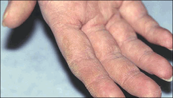 Antisynthetase syndrome