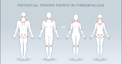 Fibromyalgia Disease