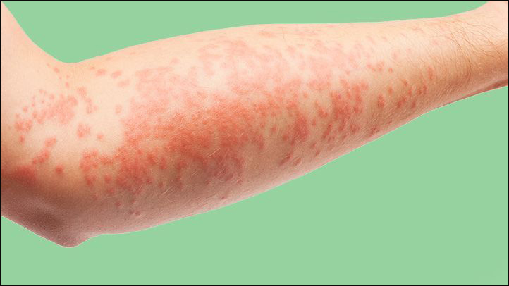 Atopic Dermatitis Disease