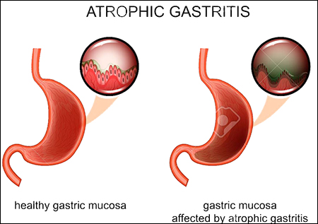 Atrophic Gastritis